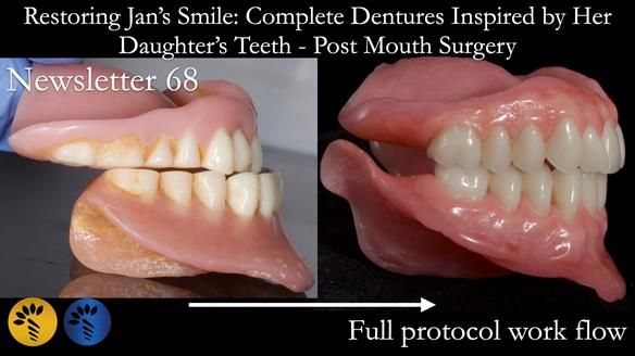 Newsletter 68 Restoring Jan’s Smile: Complete Dentures Inspired by Her Daughter’s Teeth - Post Mouth Surgery