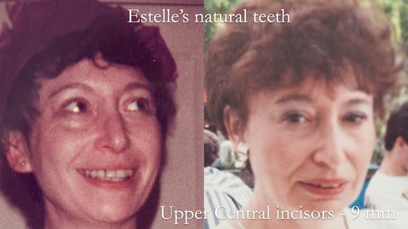 Newsletter 49 Managing Estelle’s failing implants with dentures FULL PROTOCOL