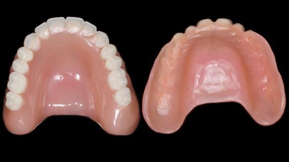 Newsletter 70 Complete Denture Treatment for Kate: A Case Study on Natural-Looking Dentures and Implant-Supported Overdentures