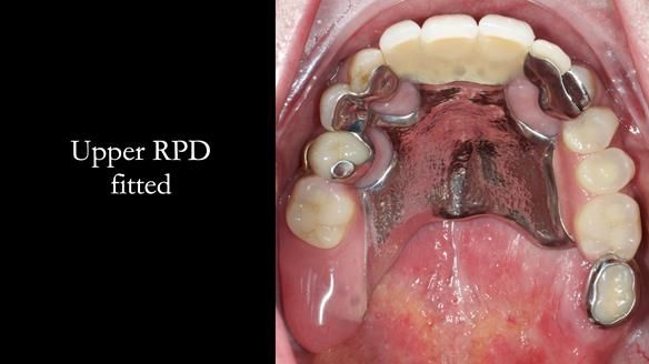 Managing Edgar “THE SCEPTIC” with an RPD/Splint FULL CASE