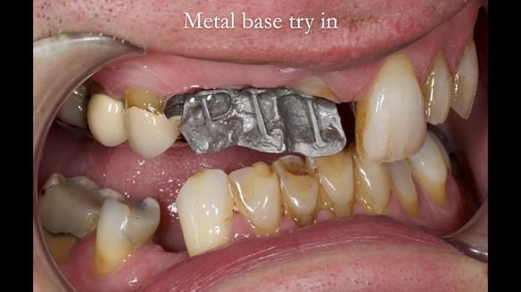 Read Newsletter 67 - Brian's COMBAT DENTURE Case Study