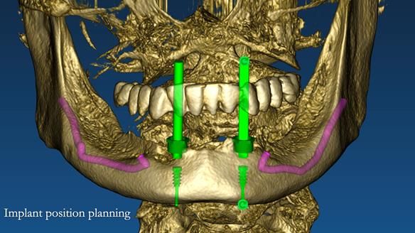 Newsletter 70 Complete Denture Treatment for Kate: A Case Study on Natural-Looking Dentures and Implant-Supported Overdentures