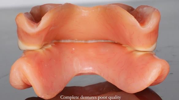 Newsletter 65 Marisa Provision of Complete Dentures on badly placed implants