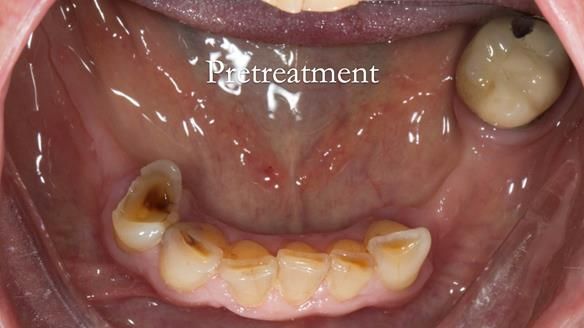 Eileen's transformation with upper and lower RPDs of Scandinavian hygienic design FULL PROTOCOL