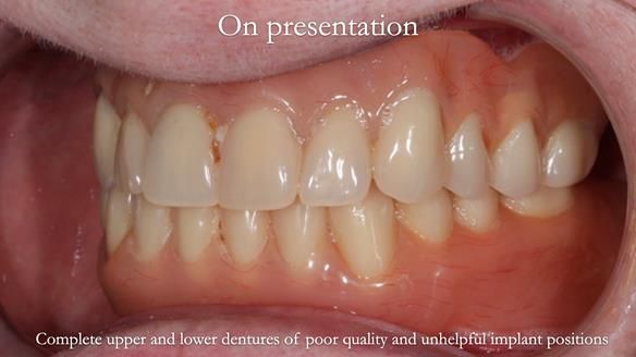 Newsletter 65 Marisa Provision of Complete Dentures on badly placed implants