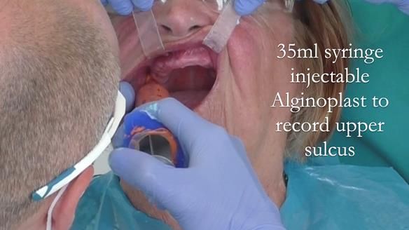 Solving Linda’s Failed “All on 4” implant bridges - full protocol Newsletter 42