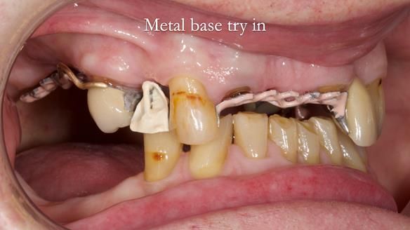 Managing Edgar “THE SCEPTIC” with an RPD/Splint FULL CASE