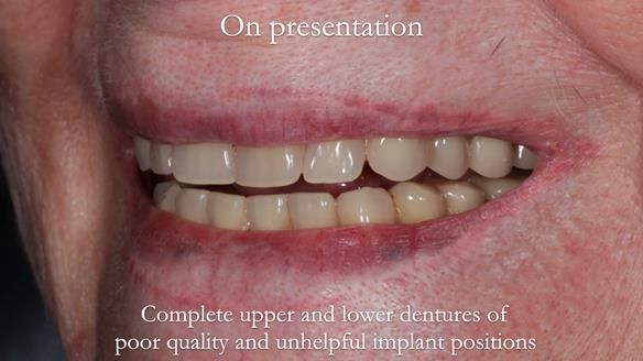 Newsletter 65 Marisa Provision of Complete Dentures on badly placed implants