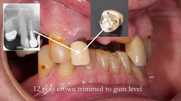 Managing Edgar “THE SCEPTIC” with an RPD/Splint FULL CASE