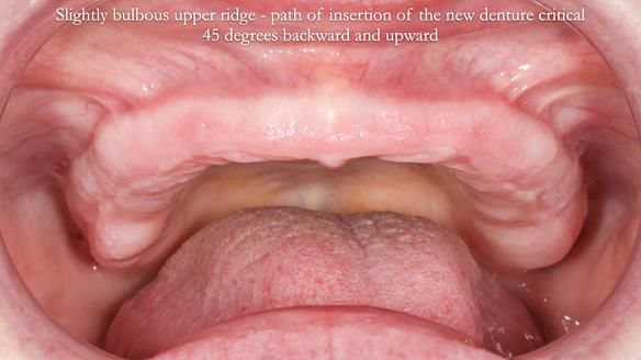 Newsletter 70 Complete Denture Treatment for Kate: A Case Study on Natural-Looking Dentures and Implant-Supported Overdentures