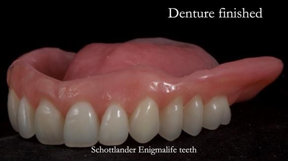 Newsletter 70 Complete Denture Treatment for Kate: A Case Study on Natural-Looking Dentures and Implant-Supported Overdentures