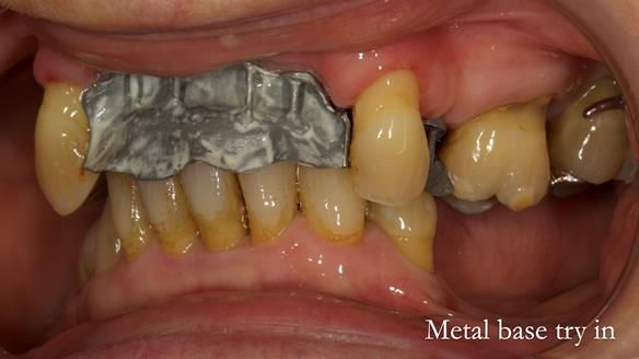 Newsletter 71 Jean’s Class I Mod III RPD: See my mistakes Fractured Mk1 to a Stronger Mk2 RPD (4 years on)