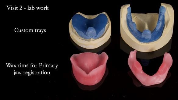 Newsletter 68 Restoring Jan’s Smile: Complete Dentures Inspired by Her Daughter’s Teeth - Post Mouth Surgery