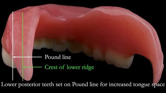 Replacing Madeline’s Complete denture FULL PROTOCOL