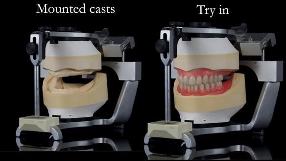 Newsletter 70 Complete Denture Treatment for Kate: A Case Study on Natural-Looking Dentures and Implant-Supported Overdentures