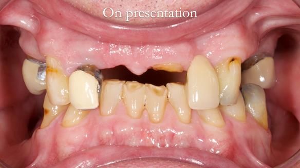 Managing Edgar “THE SCEPTIC” with an RPD/Splint FULL CASE