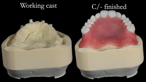 Newsletter 65 Marisa Provision of Complete Dentures on badly placed implants