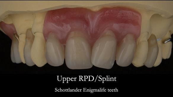 Newsletter 71 Jean’s Class I Mod III RPD: See my mistakes Fractured Mk1 to a Stronger Mk2 RPD (4 years on)