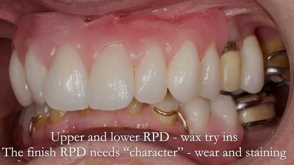 Eileen's transformation with upper and lower RPDs of Scandinavian hygienic design FULL PROTOCOL