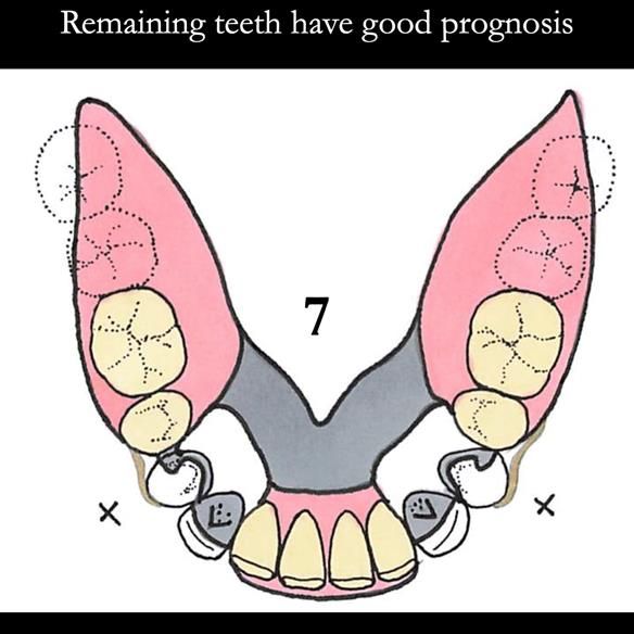 Universal Scandinavian partial denture designs