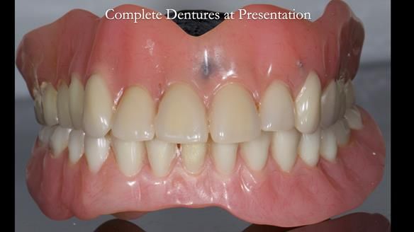 Newsletter 74: Ken’s Case Study Complete Dentures - Life Like and Age Appropriate