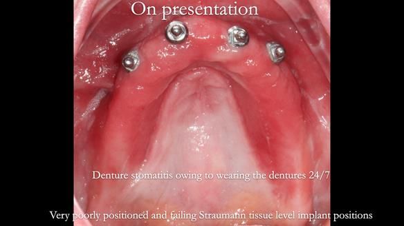 Newsletter 65 Marisa Provision of Complete Dentures on badly placed implants