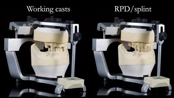 Managing Edgar “THE SCEPTIC” with an RPD/Splint FULL CASE