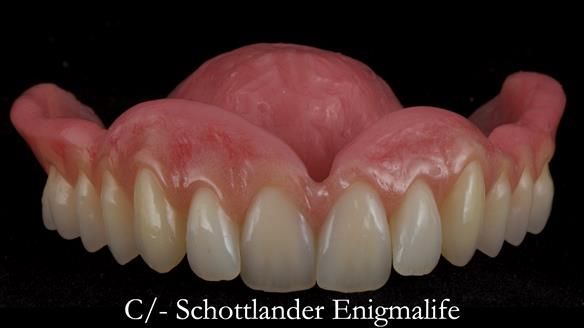 Newsletter 48 Mavis's Complete denture FULL PROTOCOL