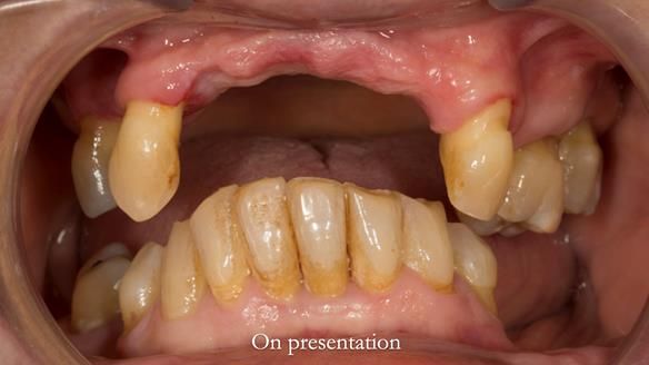 Newsletter 71 Jean’s Class I Mod III RPD: See my mistakes Fractured Mk1 to a Stronger Mk2 RPD (4 years on)