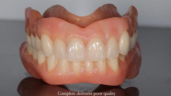 Newsletter 65 Marisa Provision of Complete Dentures on badly placed implants