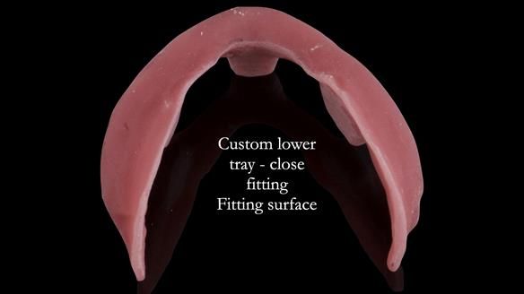 Replacing Madeline’s Complete denture FULL PROTOCOL