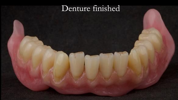 Newsletter 74: Ken’s Case Study Complete Dentures - Life Like and Age Appropriate