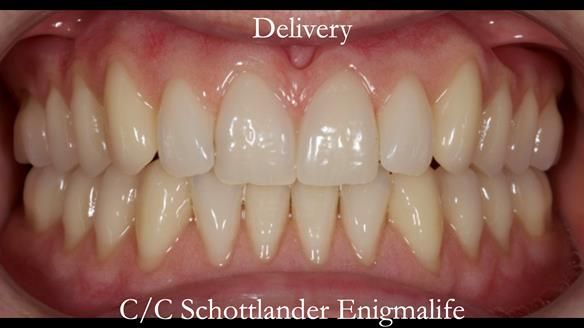 Newsletter 48 Mavis's Complete denture FULL PROTOCOL