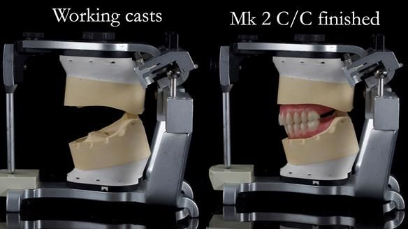 Replacing Madeline’s Complete denture FULL PROTOCOL