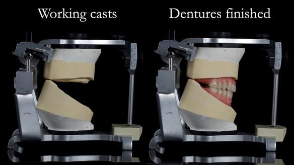 Newsletter 68 Restoring Jan’s Smile: Complete Dentures Inspired by Her Daughter’s Teeth - Post Mouth Surgery