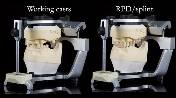 Managing Edgar “THE SCEPTIC” with an RPD/Splint FULL CASE