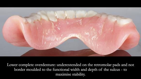 Newsletter 74: Ken’s Case Study Complete Dentures - Life Like and Age Appropriate