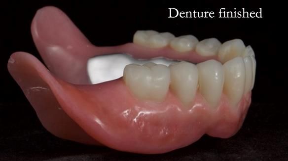 Newsletter 70 Complete Denture Treatment for Kate: A Case Study on Natural-Looking Dentures and Implant-Supported Overdentures