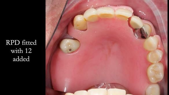 Managing Edgar “THE SCEPTIC” with an RPD/Splint FULL CASE