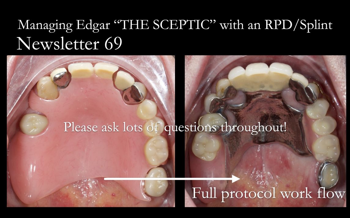 Study Club 4 Managing Edgar the Sceptic with a Scandinavian removable partial denture Finlay Sutton