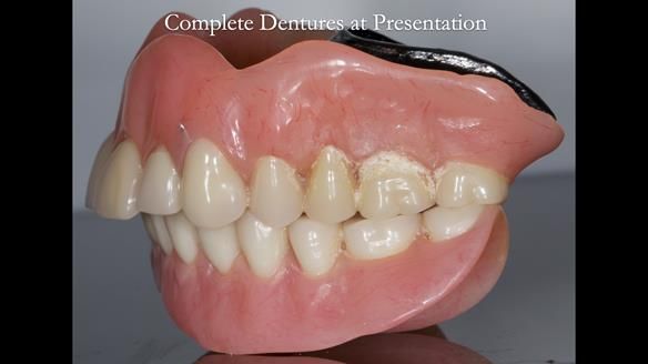 Newsletter 74: Ken’s Case Study Complete Dentures - Life Like and Age Appropriate