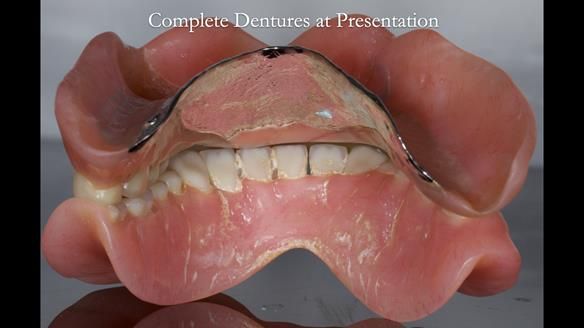 Newsletter 74: Ken’s Case Study Complete Dentures - Life Like and Age Appropriate