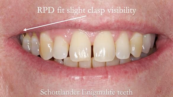 Solving Sue's failed implants with metal based RPD - full protocol Newsletter 43