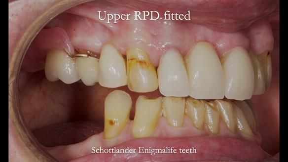 Managing Edgar “THE SCEPTIC” with an RPD/Splint FULL CASE