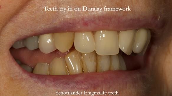 Newsletter 71 Jean’s Class I Mod III RPD: See my mistakes Fractured Mk1 to a Stronger Mk2 RPD (4 years on)