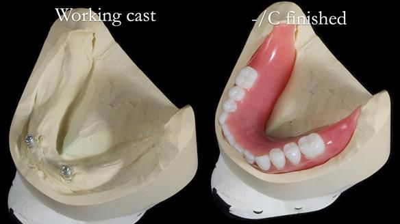 Newsletter 65 Marisa Provision of Complete Dentures on badly placed implants