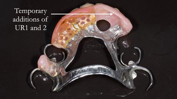 Eileen's transformation with upper and lower RPDs of Scandinavian hygienic design FULL PROTOCOL