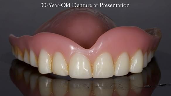 Newsletter 68 Restoring Jan’s Smile: Complete Dentures Inspired by Her Daughter’s Teeth - Post Mouth Surgery