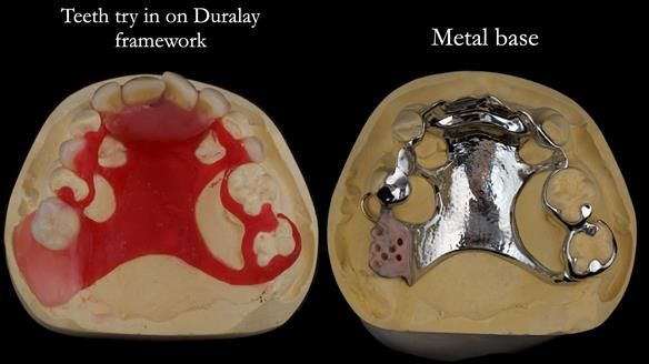 Newsletter 71 Jean’s Class I Mod III RPD: See my mistakes Fractured Mk1 to a Stronger Mk2 RPD (4 years on)