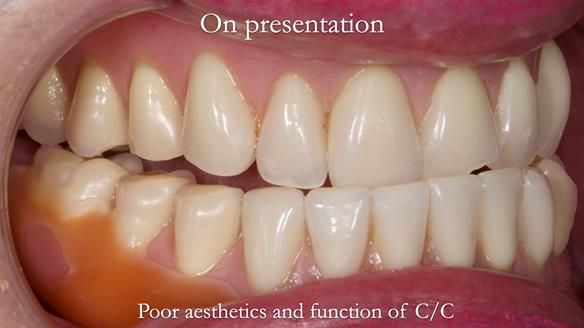 Replacing Madeline’s Complete denture FULL PROTOCOL